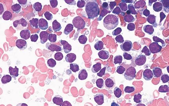 Diagnóstico de Leucemia